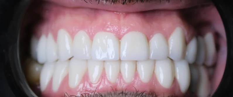 John's restored teeth after full mouth implant treatment