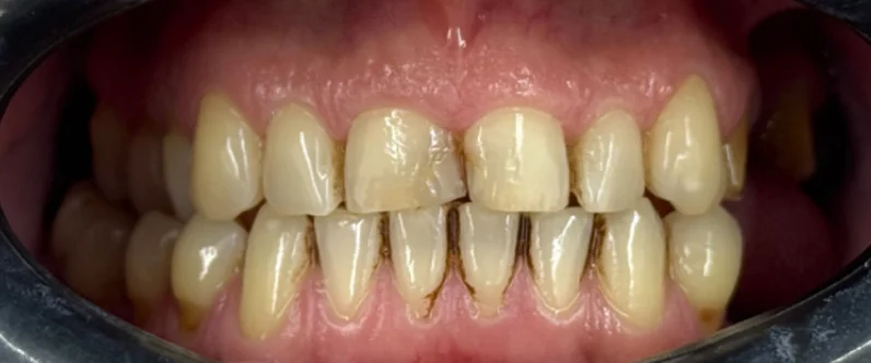 John's teeth before full mouth implant treatment