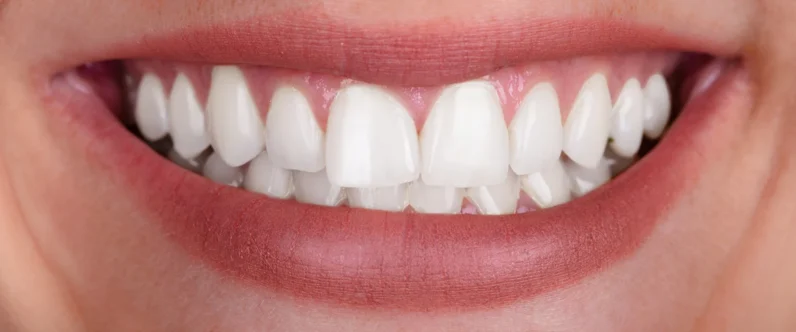 Sophie's smile after her smile makeover