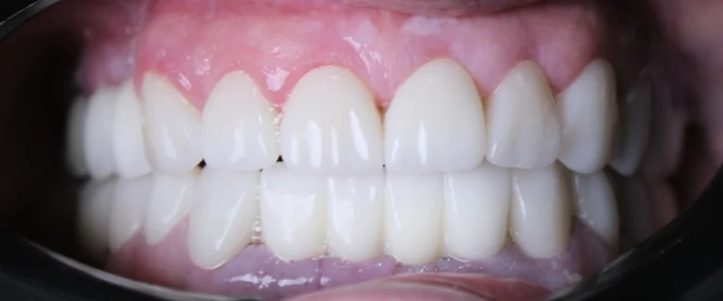 David's restored teeth after full mouth implant treatment