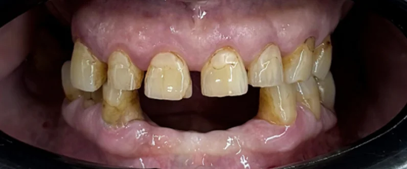 David's teeth before full mouth implant treatment