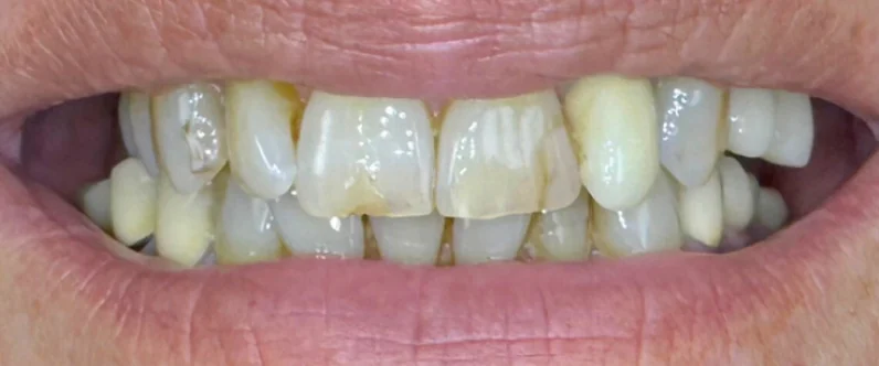 Emma's teeth before porcelain veneers treatment